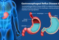 Gastroesophageal Reflux Disease (GERD) Diagram illustration /Freepik
