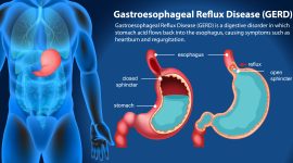 Gastroesophageal Reflux Disease (GERD) Diagram illustration /Freepik