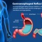 Gastroesophageal Reflux Disease (GERD) Diagram illustration /Freepik